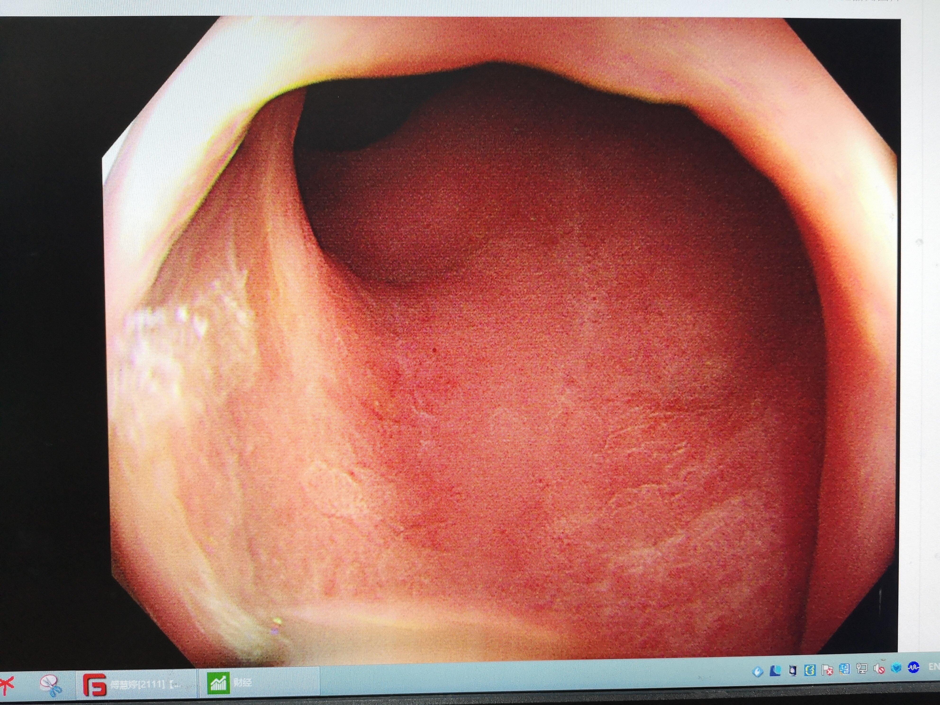直肠黏膜病变图片