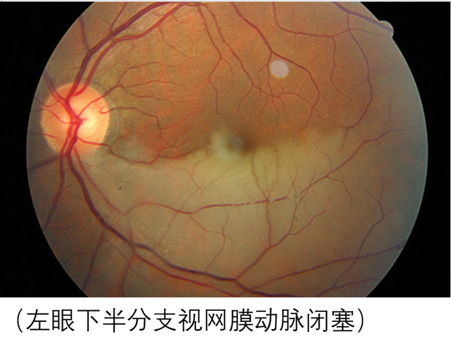 视网膜的动脉负责供应含氧量高的血液给视网膜细胞,当血管受到完全