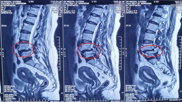 olif手术微创解决腰椎滑脱后病房里飘出幸福歌声