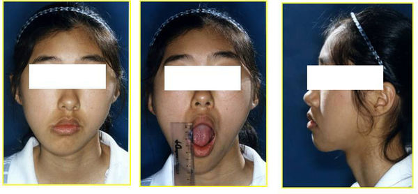 髁突高位切除术结合正畸治疗髁突肥大