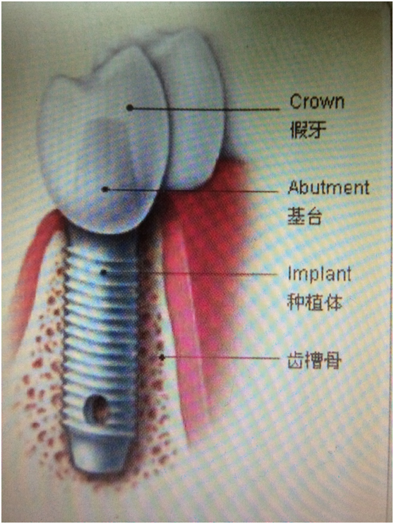 种牙是通过微创手术在缺牙部位的牙槽骨植入与人体有良好组织相容性的