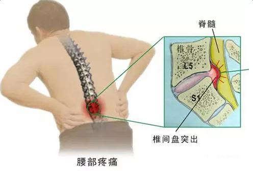 怎样判断自己得了腰椎间盘突出（怎么判断自己得了腰椎间盘突出）