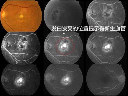 早期老年黄斑变性自我检查