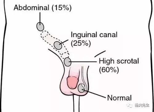关于隐睾的科普知识有些蛋蛋留不得