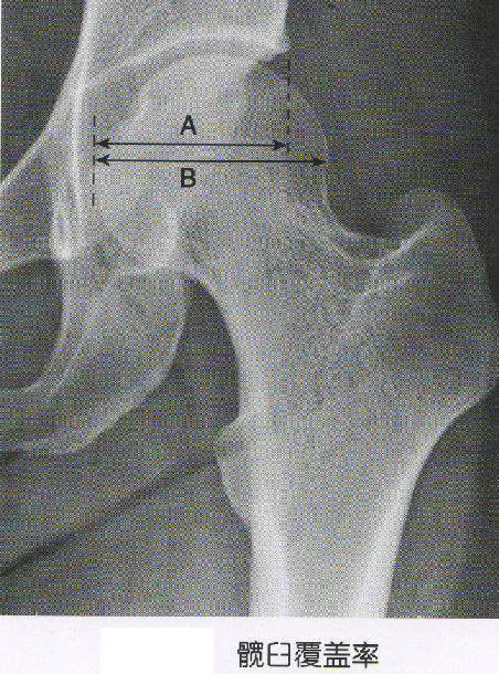 的分级方法是依据股骨头相对于髋臼的脱位程度而定,最常用的crowe法