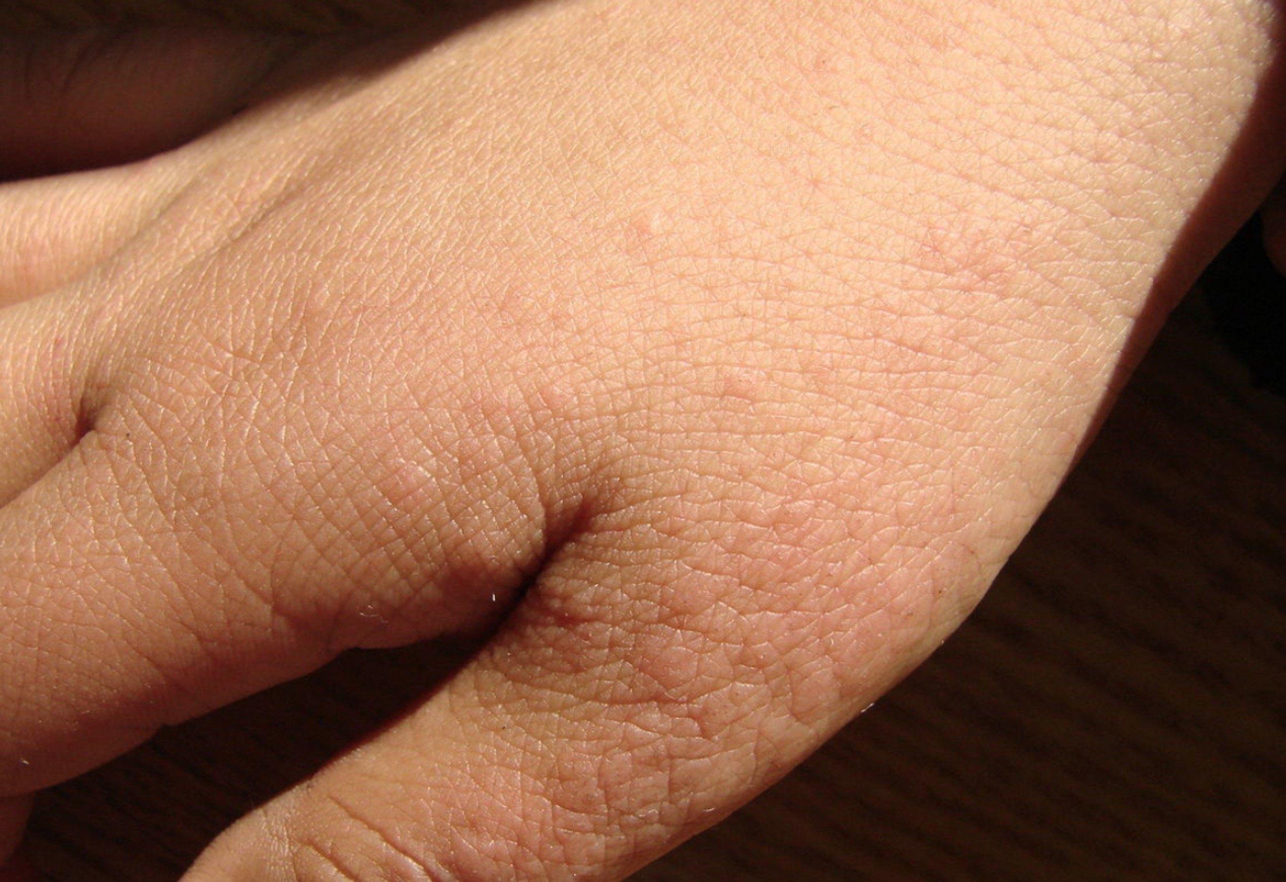 手背的丘疹沙土皮炎