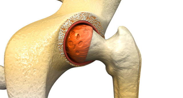 什么是髋关节滑膜炎怎么治疗髋关节滑膜炎