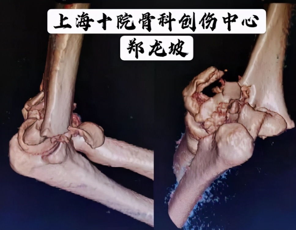 肱骨远端粉碎性骨折怎么办