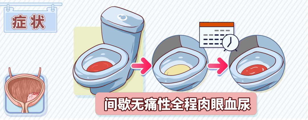 经常憋尿会导致膀胱癌尿中出现这个信号才要警惕