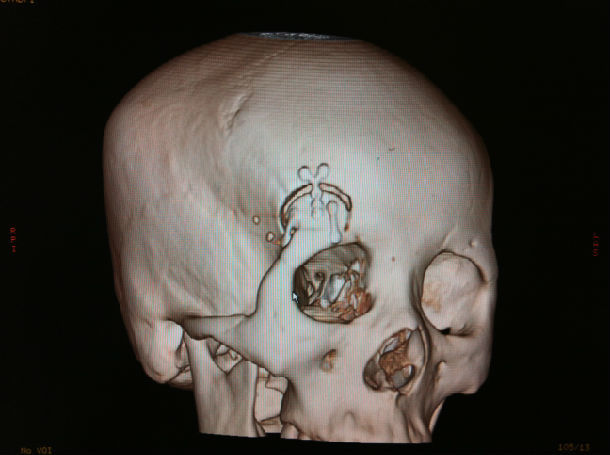 哪些颅底肿瘤患者适合手术治疗 帕金森病疼痛的三种治疗方法?