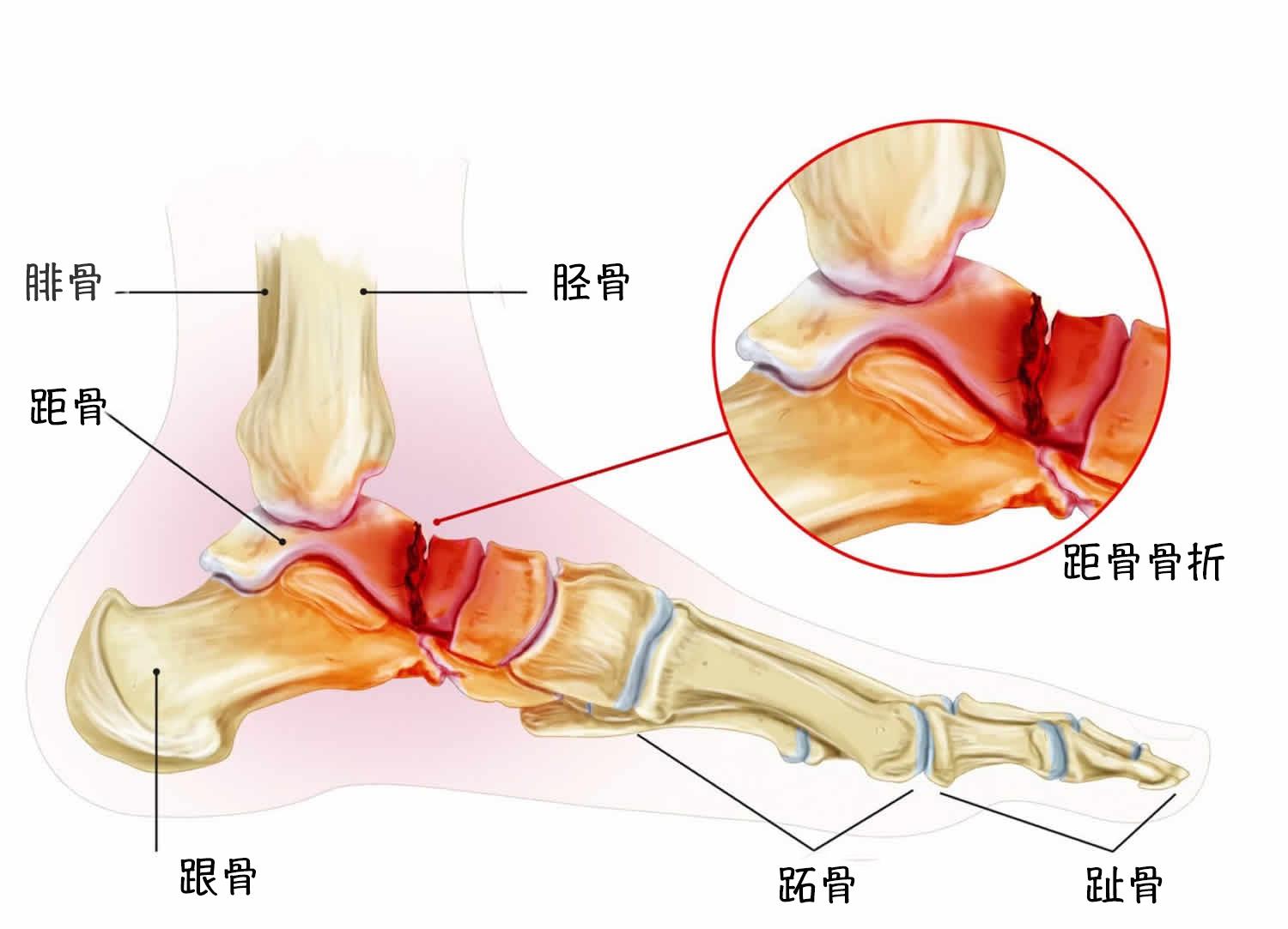 关于距骨骨折的一些常见问题解答