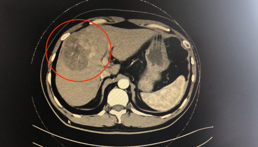 病例精选丨3d可视化成像辅助荧光导航腹腔镜肝肿瘤精准切除