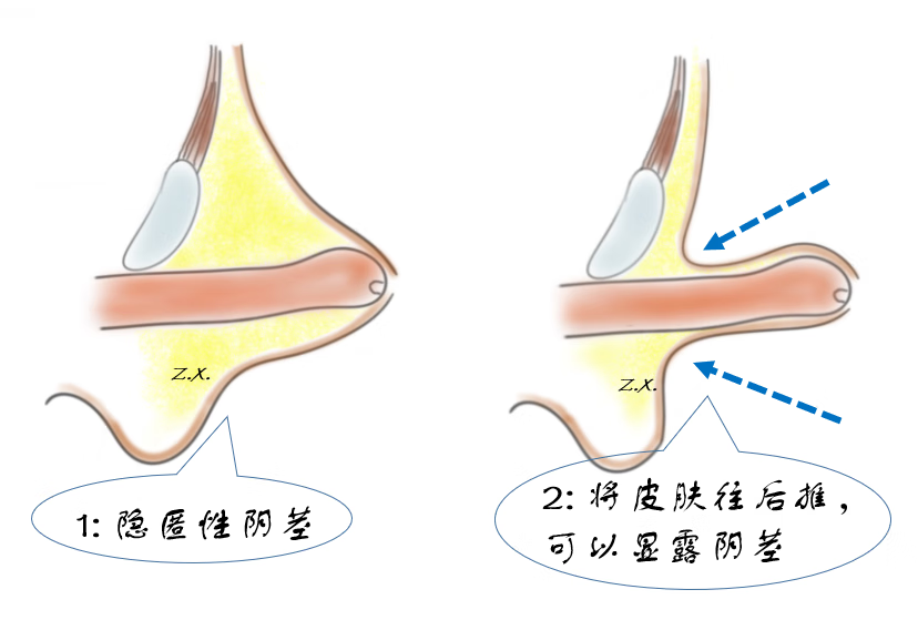 男孩丁丁短小到底要不要紧