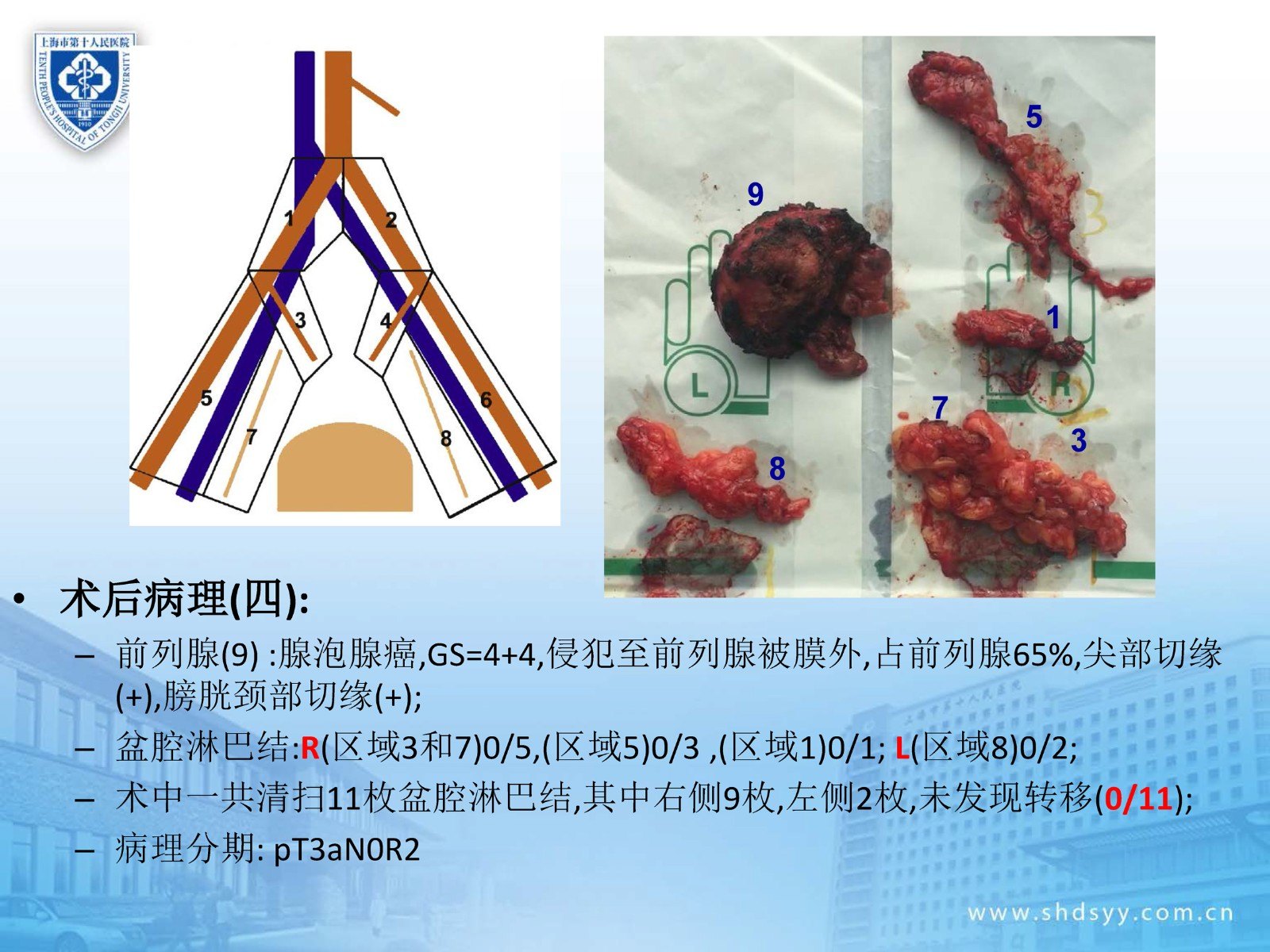 扩大盆腔淋巴结清扫在前列腺癌根治术中的应用 病例分享 微医挂号网