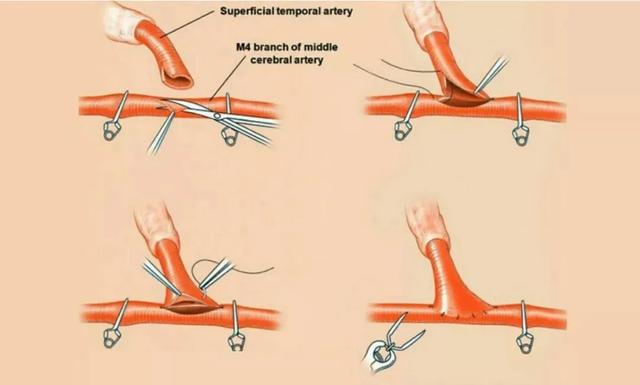 搭桥血管吻合示意图张琪博士在刘春医生协助下,在显微镜下将颅外颞