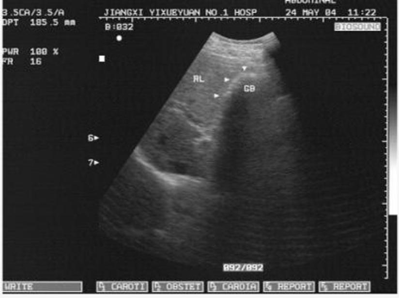 诊断胆囊炎 尤其是萎缩性胆囊炎需谨慎 健康号 微医