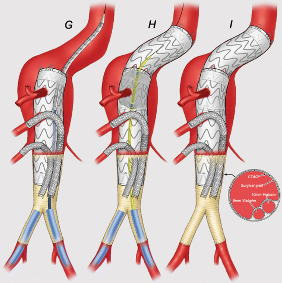 图文并行支架技术在治疗主动脉瘤时的应用