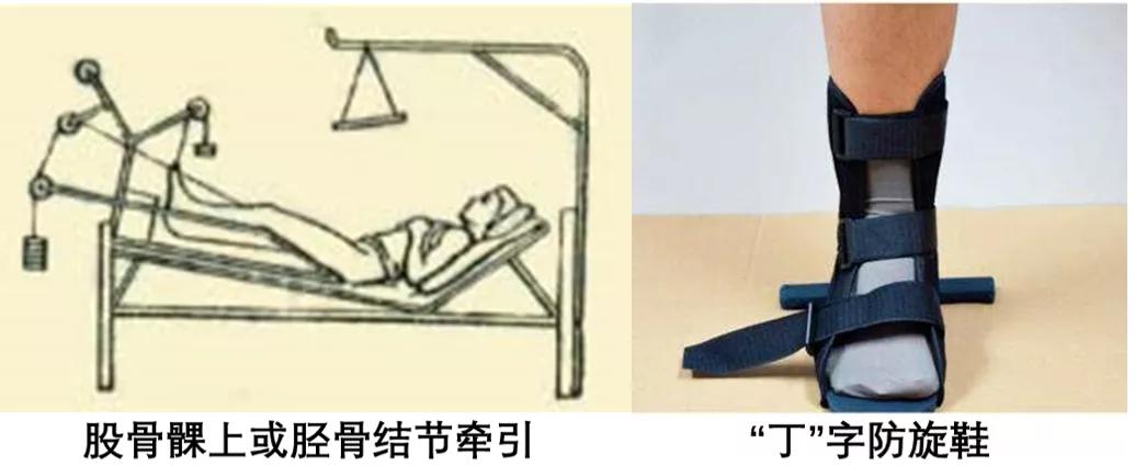 老年髋部骨折人生最后一次骨折一股骨颈骨折