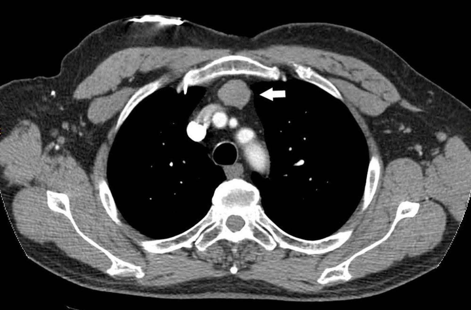 看图说肺前纵隔肿瘤胸腺瘤