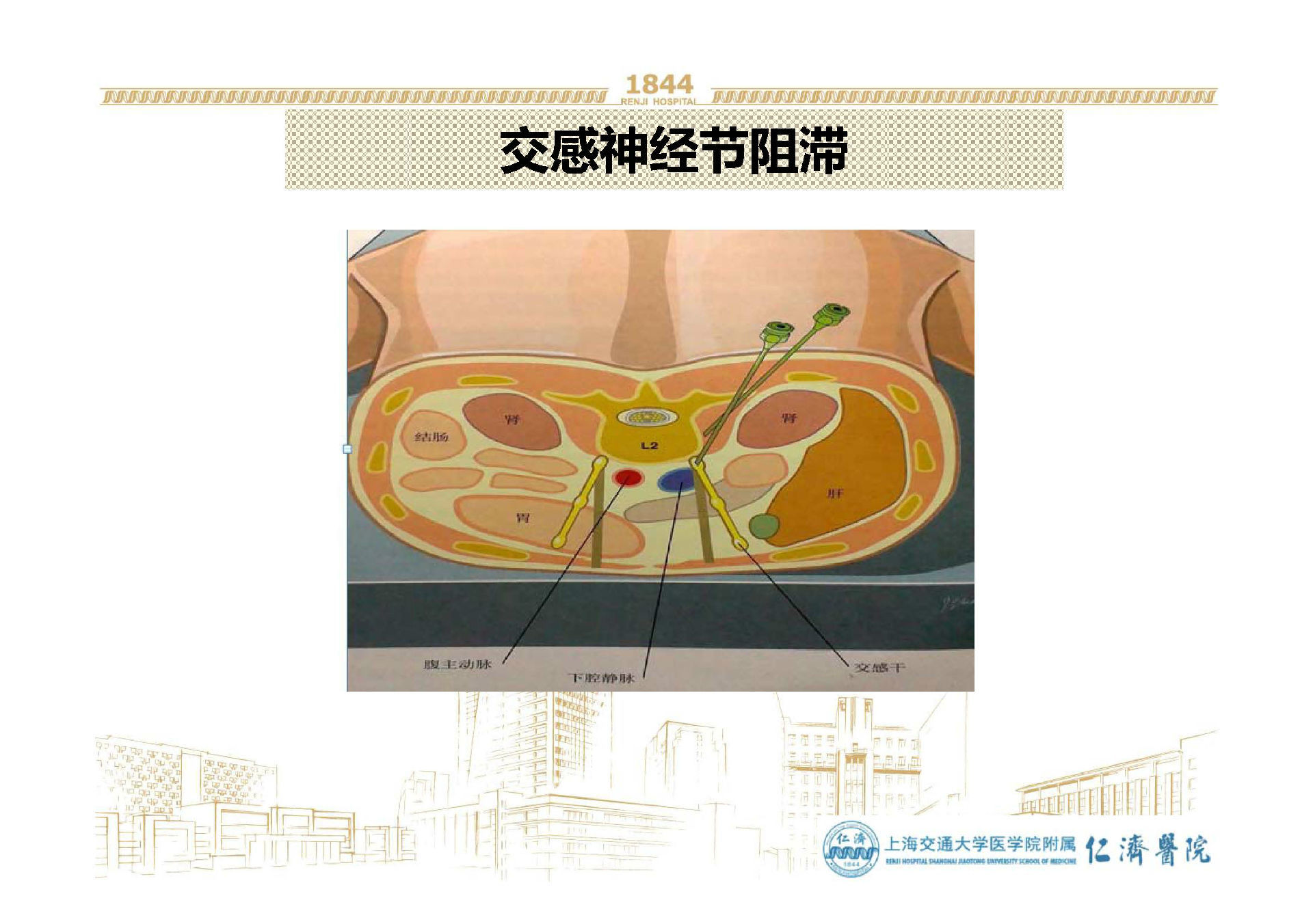 腰交感神经阻滞