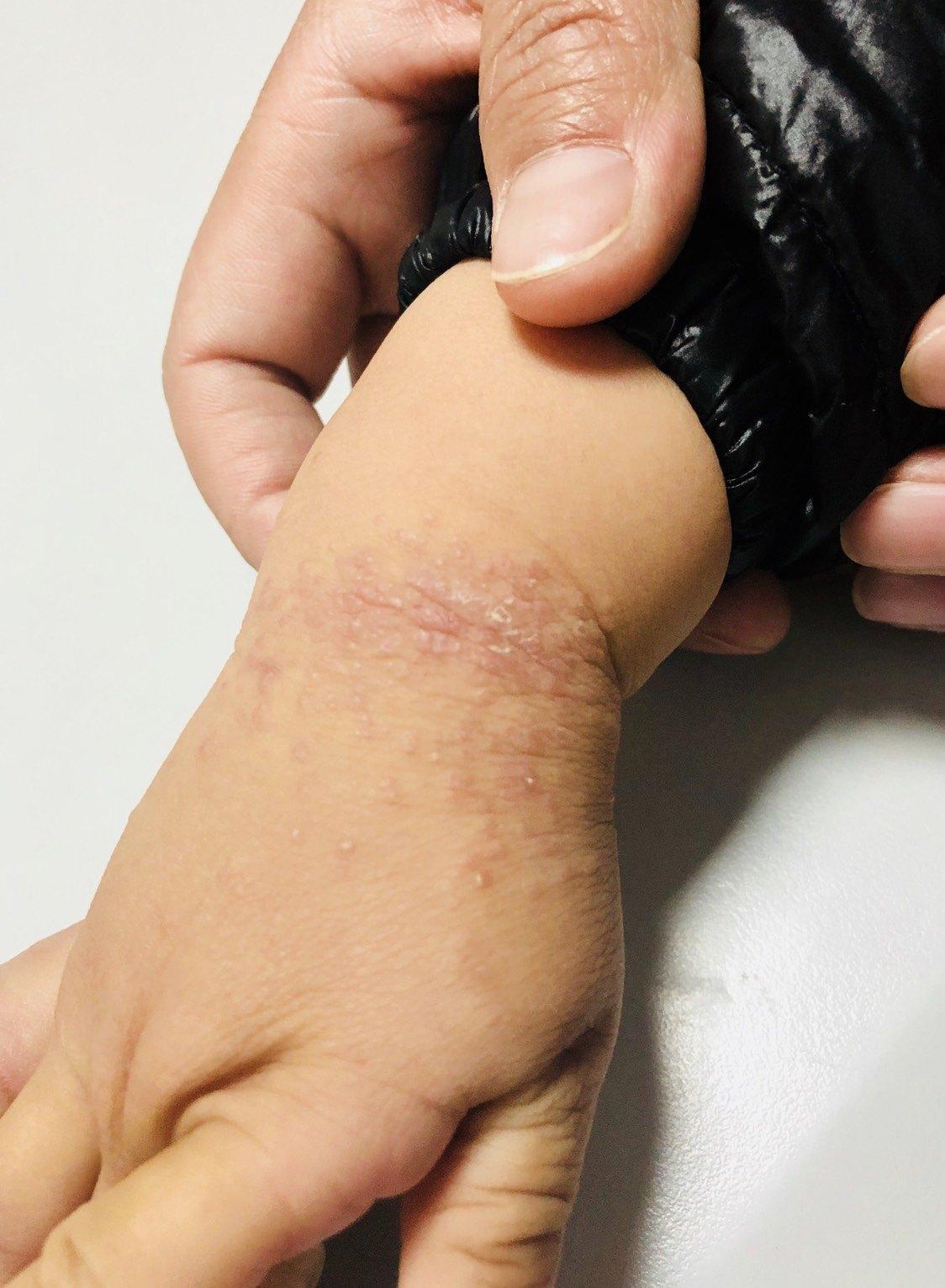 记住孩子手上这种皮疹不是湿疹