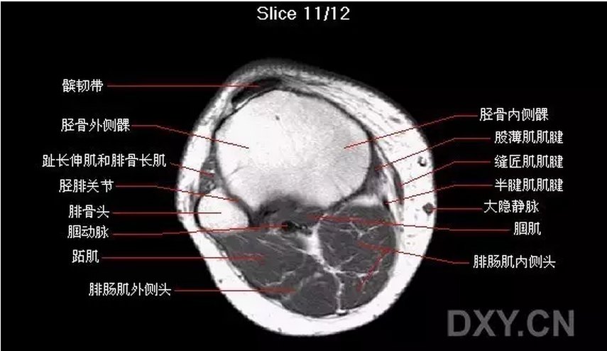 【关节影像】膝关节的磁共振(mri)解剖表现