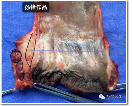 图(8):蓝色线示齿状线在白线上方,距肛门缘2-3cm.