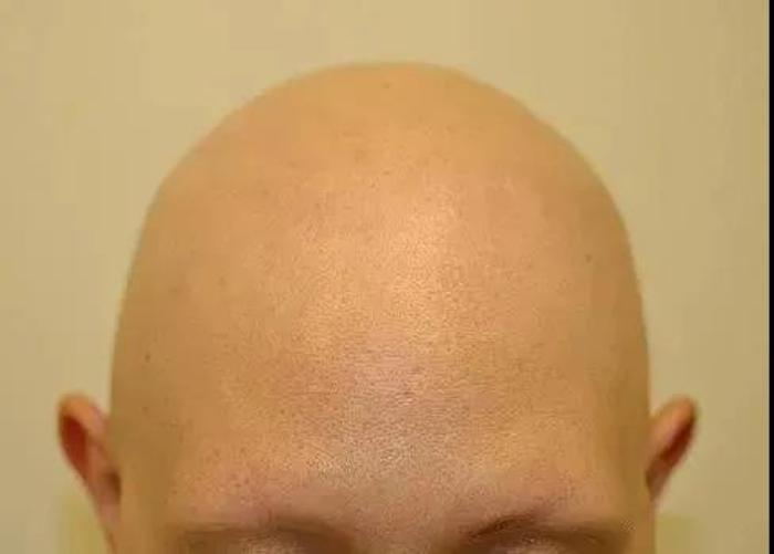 杭城皮肤病医院带你了解鬼剃头是怎么回事