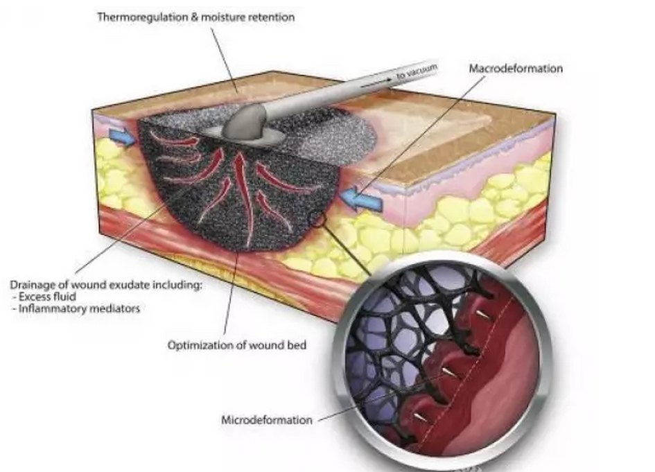 【临床技术】负压封闭引流技术在骨科的临床应用