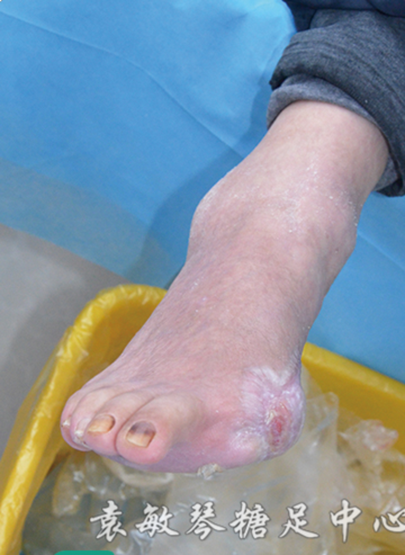 糖尿病烂脚抹什么药能长口愈合 健康号 微医