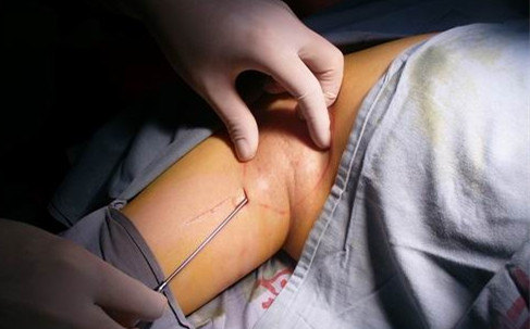 令人苦恼的腋臭 - 微医(挂号网)