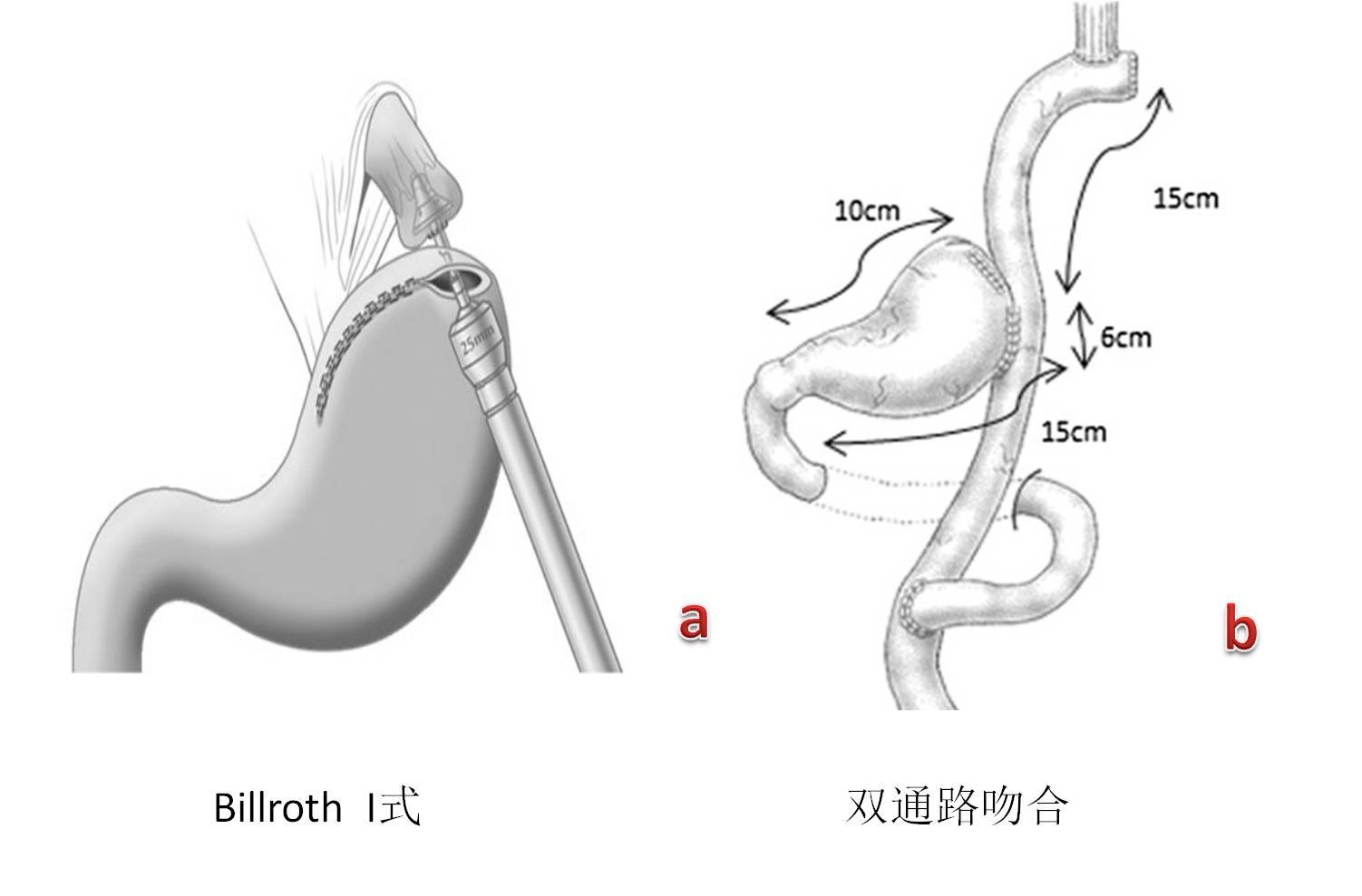 胃癌手术怎么做