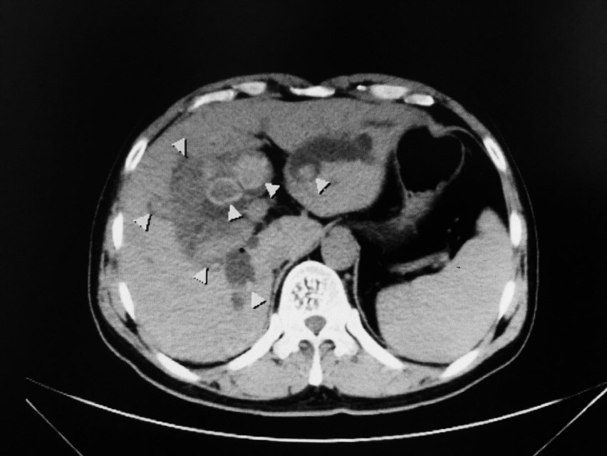 肝内胆管结石的是是非非!
