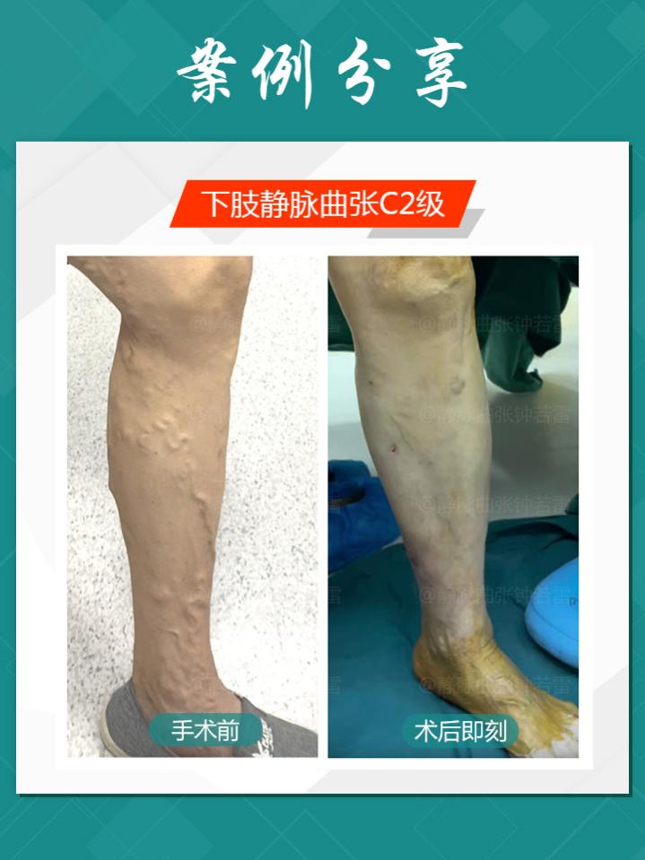 温暖的小腿青筋鼓起是为什么的照片