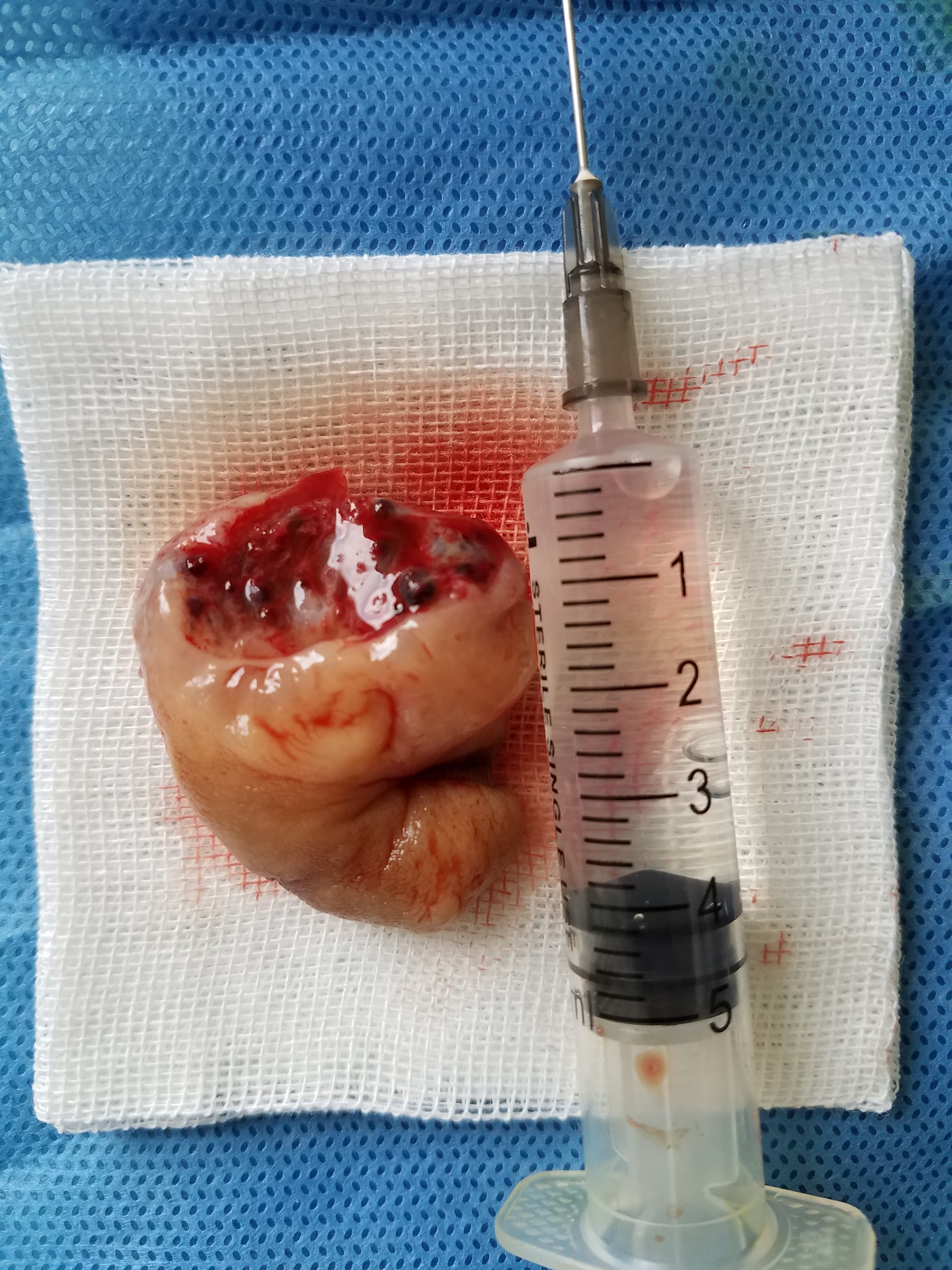 国庆值班遇到一例巨大肛乳头瘤患者