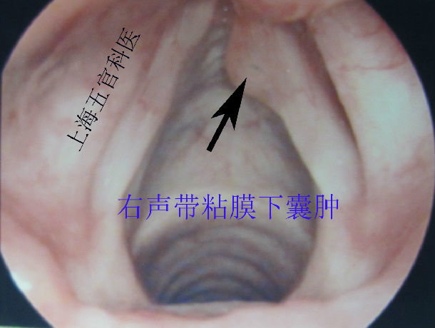声带囊肿_吴海涛医生文章_复旦大学附属眼耳鼻喉科医院-微医(挂号网)