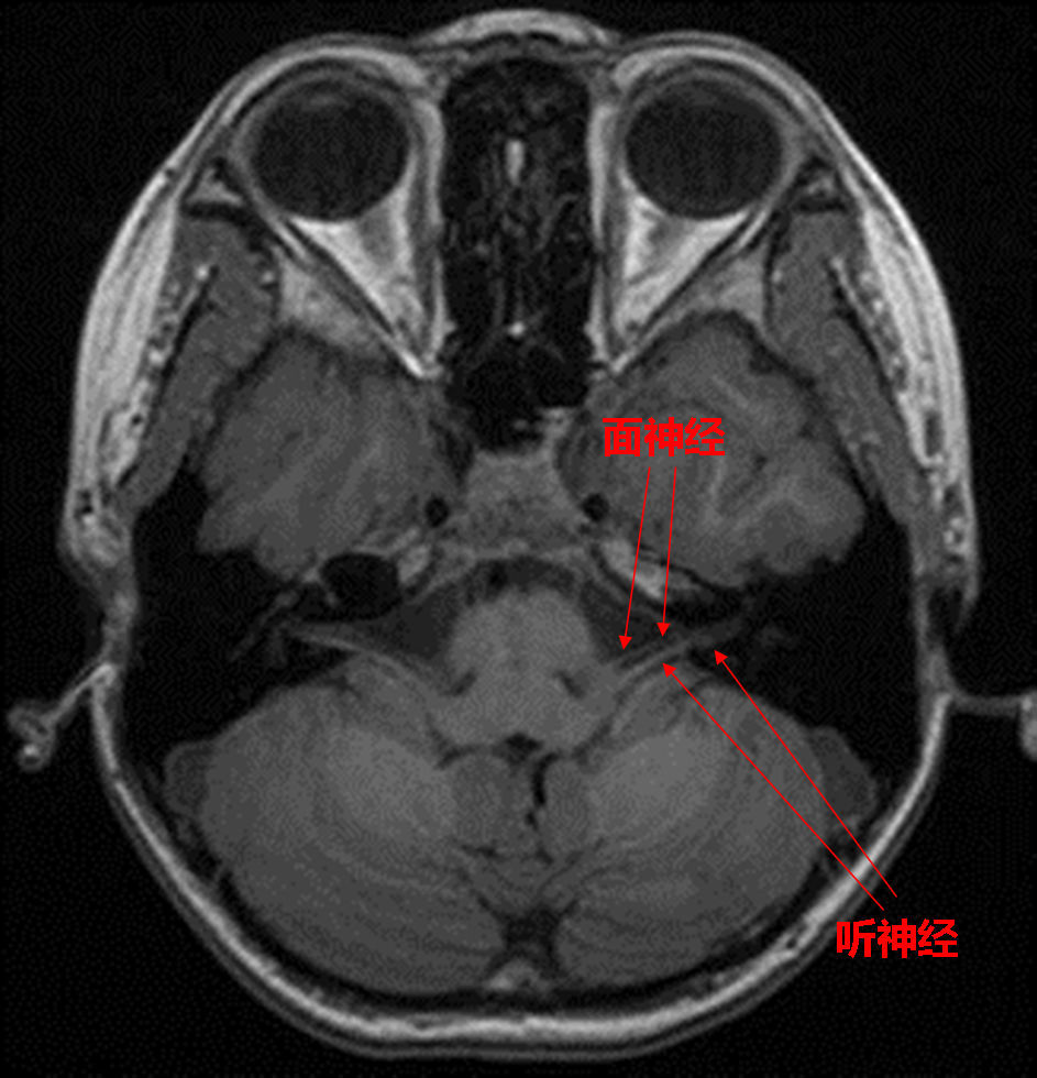 耳鸣听力下降听神经瘤的诊断与治疗