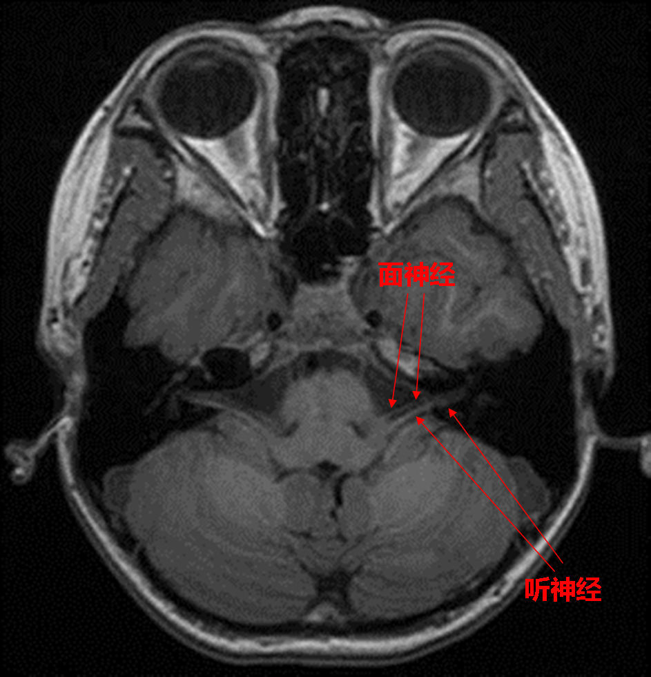 听神经瘤位置图图片