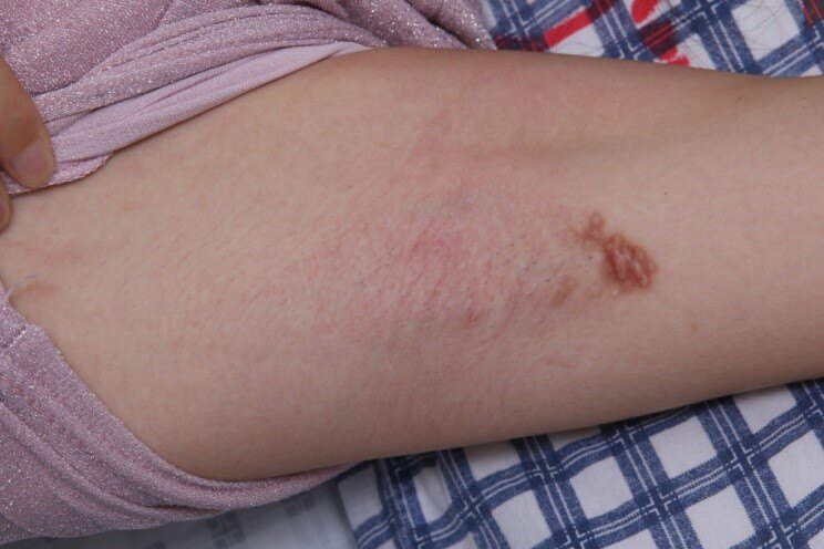 案例一:患者男,41岁,曾行三次手术治疗,腋下留有严重疤痕,但味道依然