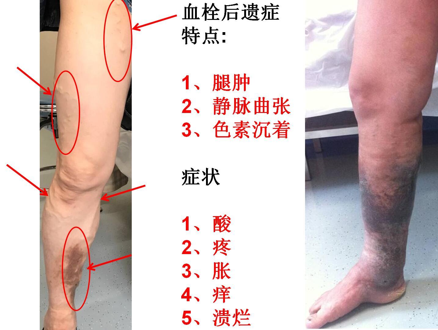 深静脉血栓怎样不留后遗症? - 微医(挂号网)