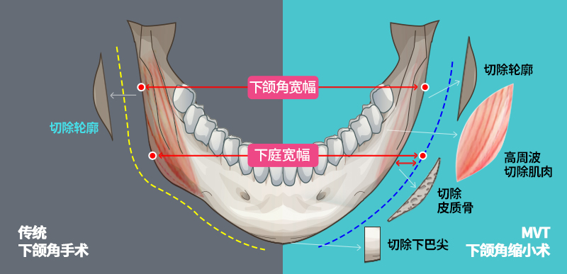 做下颌角手术前,求美者需要了解什么?