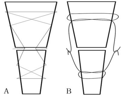急性跟腱断裂的福音——通道微创缝合技术