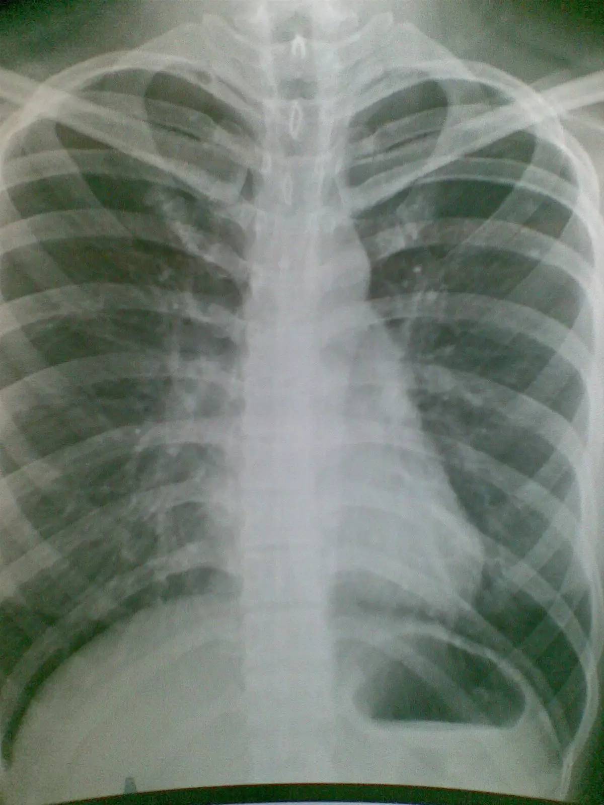胸片发现肺内钙化灶,我该怎么办?