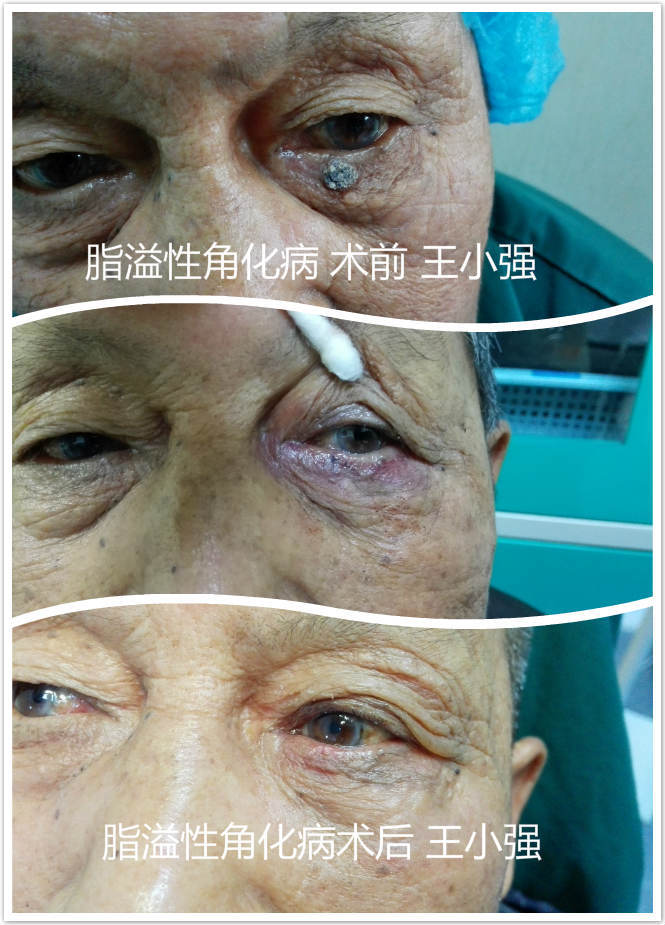 眼睑(睑缘)肿物手术注意事项(图片)_王小强医生文章_天津市眼科医院