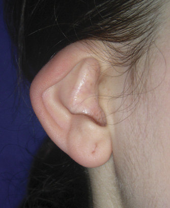 四字箴言读懂"杯状耳"整形手术全攻略(附案例效果多图).