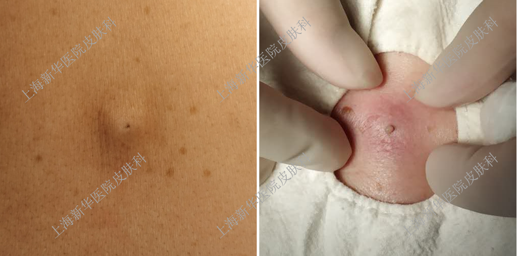 "粉瘤"是什么?该怎么治?总能挤出白色牙膏样东西.