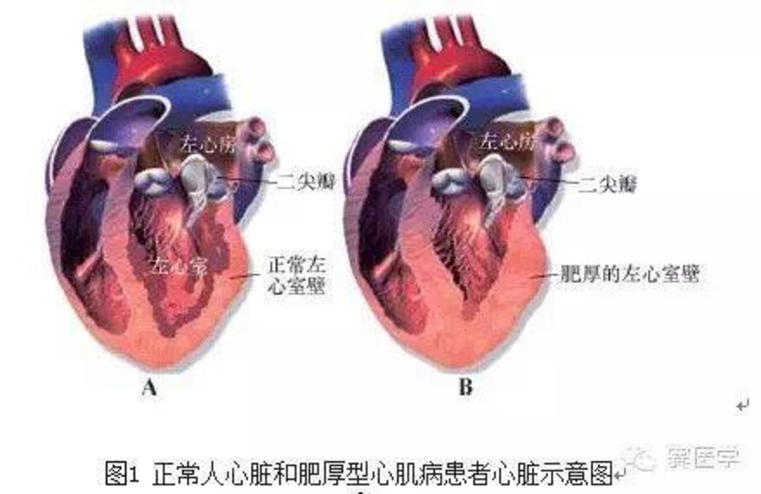 心肌肥厚,心肌细胞肥大,排列混乱和心肌间质纤维化为主要特征