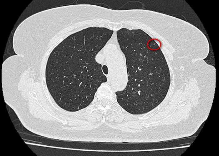 單孔胸腔鏡治療多發肺磨玻璃結節