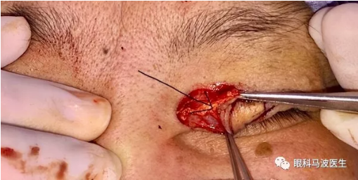 深部肌肉组织仍然可见黄色病灶)手术切除治疗眼睑黄色瘤较为彻底,对于