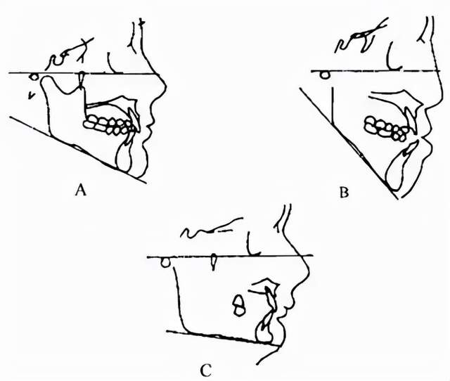 高角型与低角型下颌角应该如何改善